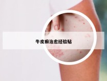 牛皮癣治愈经验贴