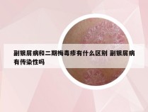 副银屑病和二期梅毒疹有什么区别 副银屑病有传染性吗