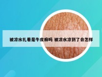 被凉水扎着是牛皮癣吗 被凉水凉到了会怎样