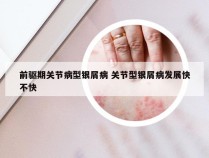 前驱期关节病型银屑病 关节型银屑病发展快不快