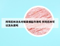 阿司匹林冼头对银屑病起作用吗 阿司匹林可以洗头屑吗