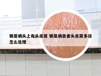 银屑病头上有头皮屑 银屑病患者头皮屑多该怎么处理