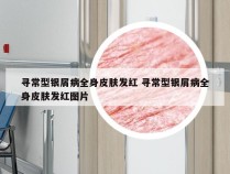 寻常型银屑病全身皮肤发红 寻常型银屑病全身皮肤发红图片