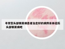 寻常型头部银屑病患者治愈好的病例亲身经历 头部银屑病吧