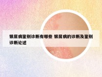 银屑病鉴别诊断有哪些 银屑病的诊断及鉴别诊断论述