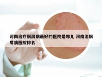 河南治疗银屑病最好的医院是哪儿 河南治银屑病医院排名
