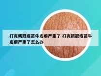打完新冠疫苗牛皮癣严重了 打完新冠疫苗牛皮癣严重了怎么办