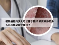 银屑病停药多久可以怀孕最好 银屑病停药多久可以怀孕最好要孩子