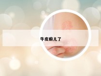 牛皮癣儿了
