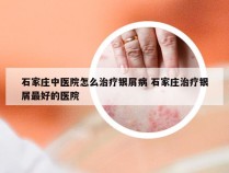 石家庄中医院怎么治疗银屑病 石家庄治疗银屑最好的医院
