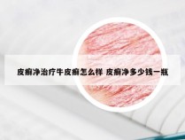 皮癣净治疗牛皮癣怎么样 皮癣净多少钱一瓶