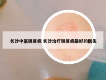 长沙中医银屑病 长沙治疗银屑病最好的医生
