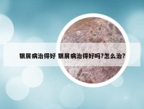 银屑病治得好 银屑病治得好吗?怎么治?
