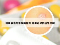 哪里收治疗牛皮癣秘方 哪里可以根治牛皮癣