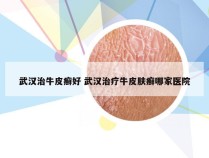 武汉治牛皮癣好 武汉治疗牛皮肤癣哪家医院