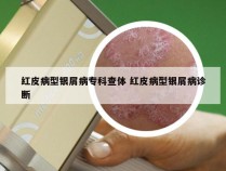 红皮病型银屑病专科查体 红皮病型银屑病诊断