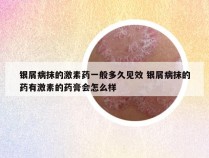 银屑病抹的激素药一般多久见效 银屑病抹的药有激素的药膏会怎么样