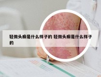 轻微头癣是什么样子的 轻微头癣是什么样子的