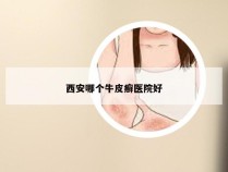 西安哪个牛皮癣医院好