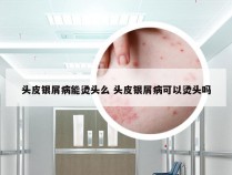头皮银屑病能烫头么 头皮银屑病可以烫头吗