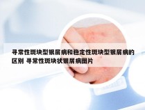 寻常性斑块型银屑病和稳定性斑块型银屑病的区别 寻常性斑块状银屑病图片