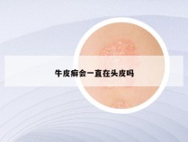 牛皮癣会一直在头皮吗