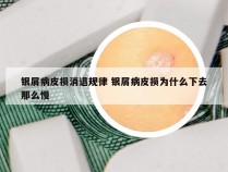 银屑病皮损消退规律 银屑病皮损为什么下去那么慢
