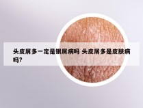 头皮屑多一定是银屑病吗 头皮屑多是皮肤病吗?