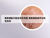 银屑病能不能吃花生呀菜 银屑病患者可以吃花生吗