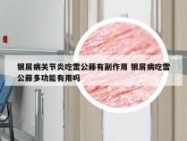 银屑病关节炎吃雷公藤有副作用 银屑病吃雷公藤多功能有用吗