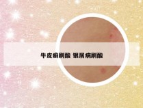 牛皮癣刷酸 银屑病刷酸