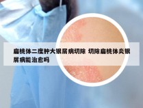 扁桃体二度肿大银屑病切除 切除扁桃体炎银屑病能治愈吗