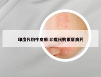 印度代购牛皮癣 印度代购银屑病药