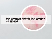 银屑病一针见效药好不好 银屑病一针6000有副作用吗
