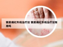 银屑病红外线治疗仪 银屑病红外线治疗仪有用吗