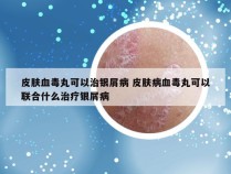 皮肤血毒丸可以治银屑病 皮肤病血毒丸可以联合什么治疗银屑病