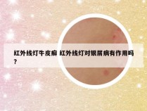 红外线灯牛皮癣 红外线灯对银屑病有作用吗?