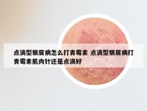点滴型银屑病怎么打青霉素 点滴型银屑病打青霉素肌肉针还是点滴好