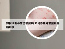 如何诊断寻常型银屑病 如何诊断寻常型银屑病症状