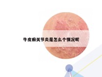 牛皮癣关节炎是怎么个情况呢
