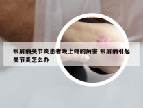 银屑病关节炎患者晚上疼的厉害 银屑病引起关节炎怎么办