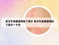 多少牛皮癣遗传给了孩子 多少牛皮癣遗传给了孩子一个月