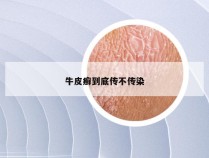 牛皮癣到底传不传染