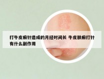 打牛皮癣针造成的月经时间长 牛皮肤癣打针有什么副作用