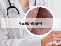牛皮癣打针能治好吗