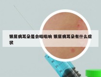 银屑病耳朵是会嗡嗡响 银屑病耳朵有什么症状
