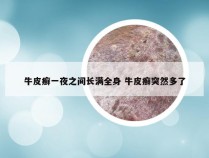 牛皮癣一夜之间长满全身 牛皮癣突然多了
