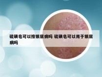 硫磺皂可以擦银屑病吗 硫磺皂可以用于银屑病吗