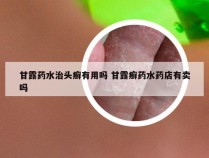 甘露药水治头癣有用吗 甘露癣药水药店有卖吗
