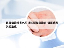银屑病治疗多久可以达到临床治愈 银屑病多久能治愈